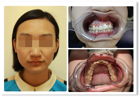 3D全透明隐形矫正,看不见的牙套 看得见的牙齿一天天变齐